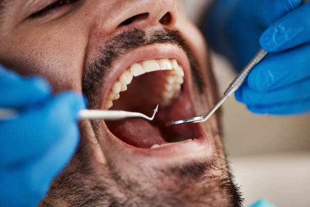Best Emergency Tooth Extraction in Liberty, SC